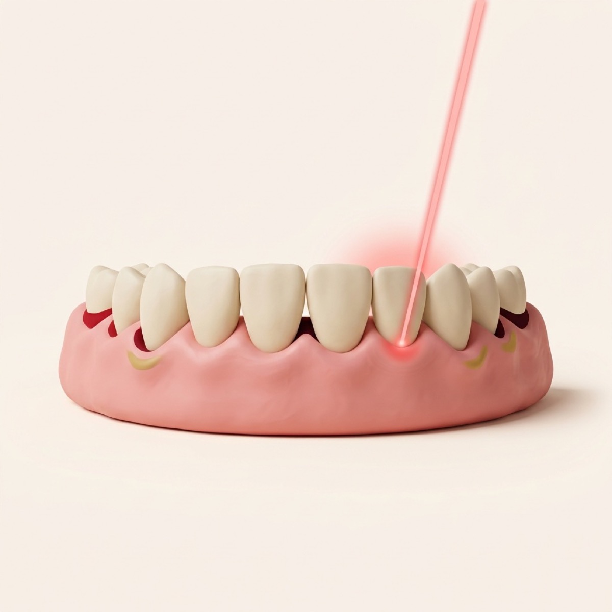 Illustration of a soft laser beam treating the gum line